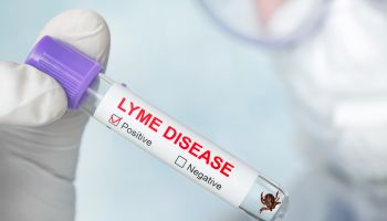 Lyme disease label on a test tube in the hands of a laboratory assistant. dangerous carrier of Lyme disease in glass vial in a doctor's office. Diagnosing patients after a tick bite.