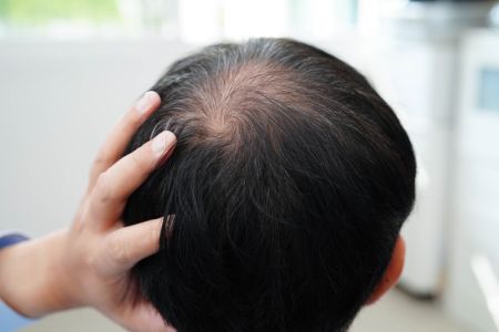 Hair Loss Products